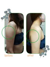 ダイエット サポート(DIET SUPPORT)/グロッティ２　腕　施術結果