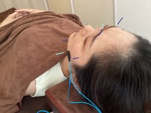 ハリファ鍼灸院 横浜関内院(HariFa鍼灸院)/美容施術/美容鍼