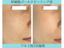 リメイククリニカルビューティー(Remake clinical beauty)/毛穴の開きには
