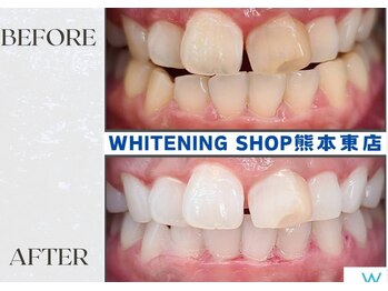 ホワイトニングショップ熊本東店/