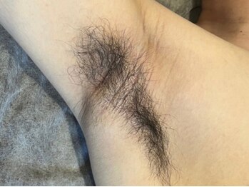 ヨハク(YOHAKU)/30代前半　男性　10回施術before