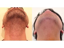 シャイン(SHINE)/メンズ髭脱毛before、after