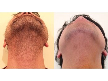 シャイン(SHINE)/メンズ髭脱毛before、after