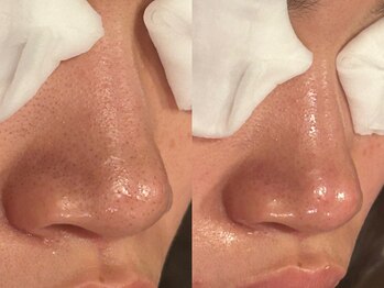 ビーフリー(Be free)/毛穴改善コース