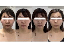 レトラ鍼灸院/美容鍼＋デコルテ