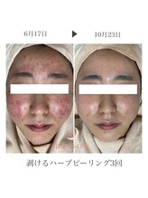 ルボン 宮崎店(RUBON)/剥けるハーブピーリング