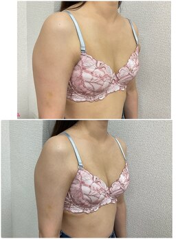 バーディー(BIRDIE)/施術１回/2０代