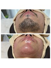 はだころも/メンズ ヒゲ コラボ脱毛