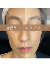 サンポ 神戸元町店(SANPO)/血管ケア×エクソソーム導入