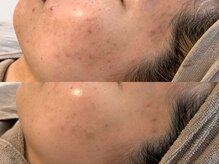 ピブ(PIBU)/ニキビ症例/ハーブピーリング