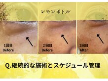 オートクチュール エステティックサロン シーズ/継続的な施術とスケジュール管理