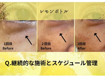 オートクチュール エステティックサロン シーズ/継続的な施術とスケジュール管理