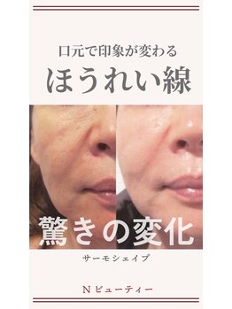 Nビューティー/最新RFサーモシェイプオーパス