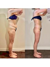 カルナ(CARNA)/【痩身】セルライトゼロ2