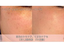 オーシャンブルー 時津店(OCEAN BLUE)/シミケア(スノーホワイトピール)