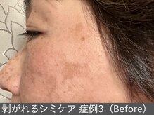 オアシスラグーン(OASIS LAGOON)/シミケア（症例3 before）60代