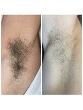 ムーナボーテ(Moona Beaute)/光脱毛