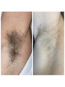 ムーナボーテ(Moona Beaute)/光脱毛