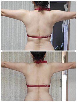 キミーエステティックサロン(kimmy esthetic salon)/背中・二の腕コース