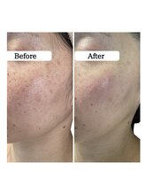 ル ボヌール 伊那店(le bonheur)/エクソソームハーブ　すごい結果