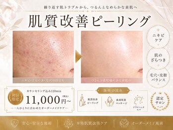 ルチル 八女店(Rutile)の写真/"初めての方にはこのメニューがおすすめ☆"肌悩み別ピーリング《クリスティーナ/韓国肌管理/水光LDM》