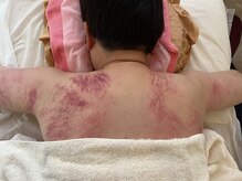 手もみ屋/両肩の痕　疲れすぐみられます