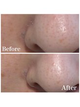 ピュア 川越店/毛穴改善コース