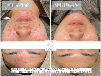 ラヴィオーラ 川崎(La Viora)/ダイヤモンドハーブピーリング