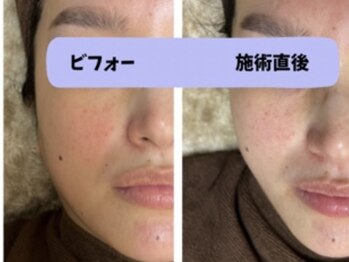 アイリー(IRIE)/インモード　ワンセラ