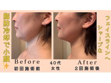 レパード/脂肪冷却でスッキリ小顔！