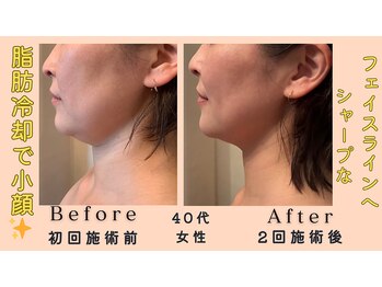 レパード/脂肪冷却でスッキリ小顔!