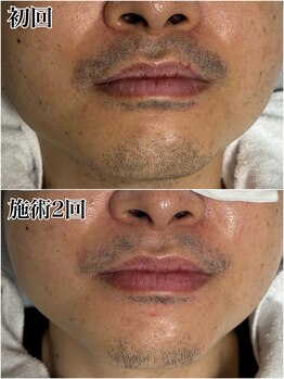 ルシャトン(Le Chaton)/ヒゲ脱毛