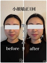 リバイブ 自由が丘店(REVIVE)/小顔矯正＋ドライヘッドスパ１回