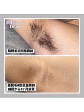 レーベン 戸畑店(Leben)/北九州市メンズ脇脱毛