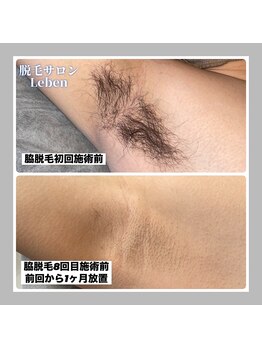 レーベン 戸畑店(Leben)/北九州市メンズ脇脱毛