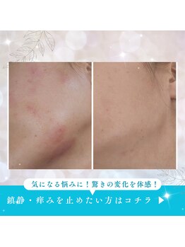 エメ(Aimer)の写真/【選べる肌管理】毎月のお肌に合わせたオーダーメイド肌質改善♪