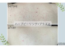 ウェルビー(Well-Be)/ハーブピーリング＋プラズマ導入