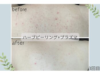 ウェルビー(Well-Be)/ハーブピーリング＋プラズマ導入