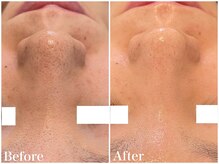 サロンドフェイス(Salon de Faith)/【ハーブピーリング】10回施術♪