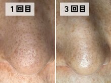 エアル(earu.)/BA|毛穴ケア|ピーリング|高円寺