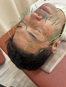 鍼灸サロン ヒマワリ(himawari)/美容鍼 男性