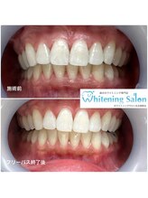 ホワイトニングサロン 名古屋駅店/【ホワイトニング施術例】