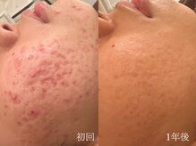 ウォーム(warm)/【肌質改善専門店warm】肌質改善