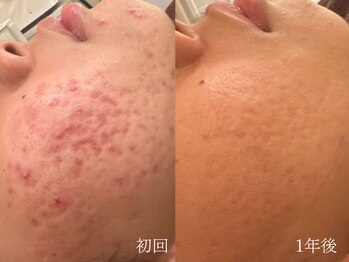 ウォーム(warm)/【肌質改善専門店warm】肌質改善