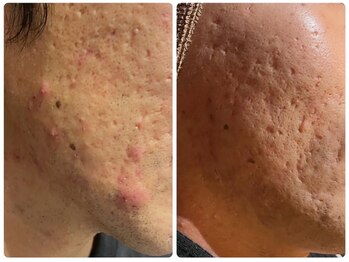 ルタンリッシュオム(Lutan Riche hom)/オイル肌卒業