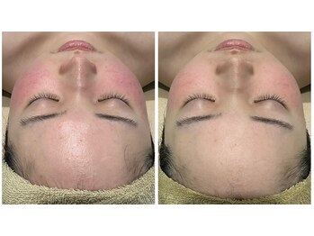 レクラ バイ ドクターエイチ(L'ECLAT by Doctor.H)/ハーブピーリング