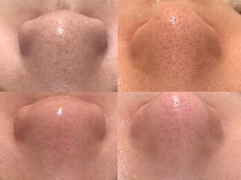 ニコレ(Nicore)/黒ずみ毛穴撃退！！