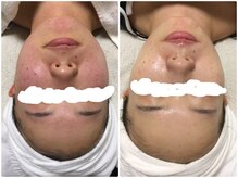 ビズビズ 天王寺店(bisebise)/ニキビ/毛穴開き黒ずみ角栓詰り