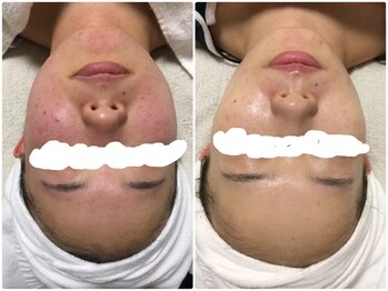 ビズビズ 天王寺店(bisebise)/ニキビ/毛穴開き黒ずみ角栓詰り