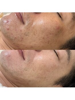 ブリス(Bliss)/肌荒れにアプローチ！